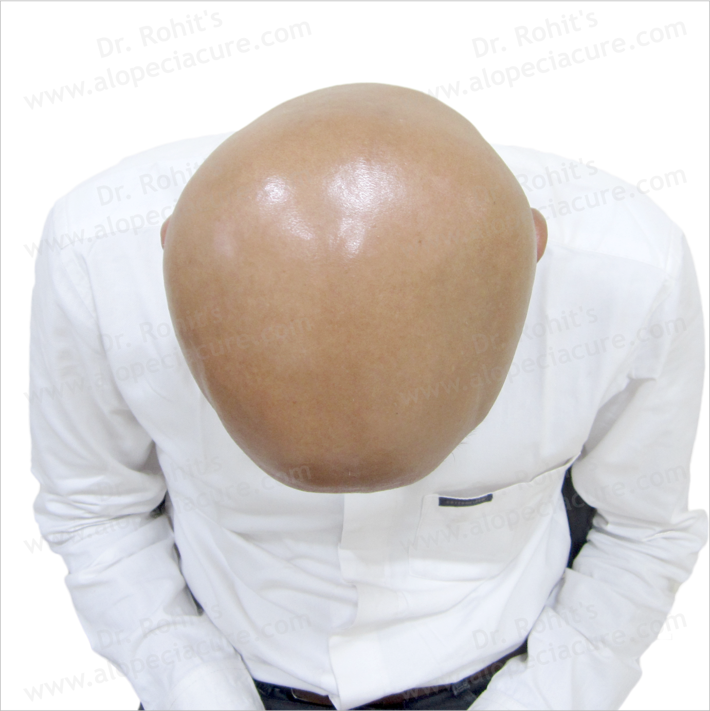 Shave off entire scalp myth